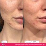 Hero Cosmetics Mighty Patch Invisible+ Daytime Hydrocolloid Acne Pimple Patches – 39 Count - Image 3