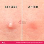 Rael Miracle Patch Invisible Spot Cover – 96 Count, 2 Sizes - Image 6